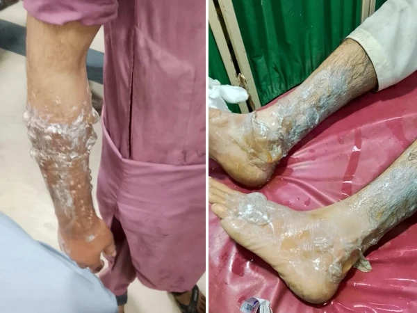 ناشتے کا بل مانگنے پر ملزم نے دکاندار کے بچوں پر گرم دودھ پھینک دیا، چاقو سے حملہ